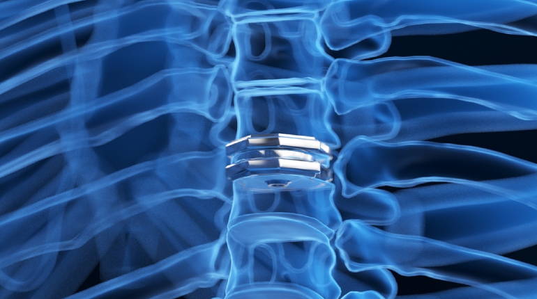 Diagram of a herniated (slipped) lumbar disc pressing on a spinal nerve, illustrating non-surgical recovery